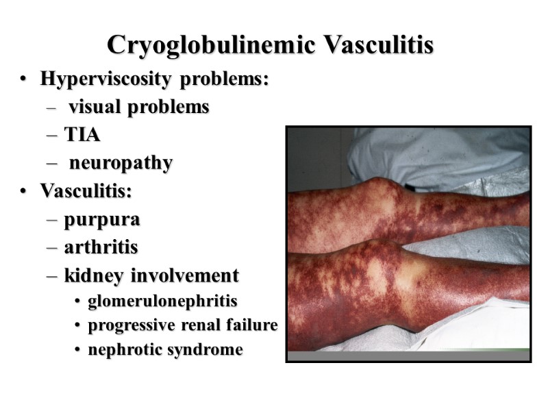 Cryoglobulinemic Vasculitis Hyperviscosity problems:  visual problems  TIA  neuropathy Vasculitis:  purpura